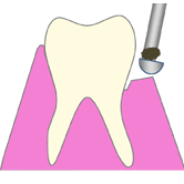 歯石・最近の除去